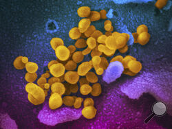 FILE - This undated, colorized electron microscope image made available by the U.S. National Institutes of Health in February 2020 shows the Novel Coronavirus SARS-CoV-2, indicated in yellow, emerging from the surface of cells, indicated in blue/pink, cultured in a laboratory. The National Institutes of Health is opening a handful of studies to start testing possible treatments for long COVID, an anxiously awaited step in U.S. efforts against the mysterious condition. The announcement, Monday, July 31, 2023