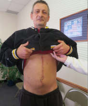 Robert Lee Longenberger Sr., 56, shows his injuries in the waiting area of District Judge Richard Knecht's office Monday. Longenberger was allegedly stabbed by his now ex-girlfriend, Linda Potoeski, 54. The knife, which left the smaller gash on his lower left abdomen, pierced his large intestine, he said. That forced doctors to cut a much larger slice, now medically stapled together, to remove a portion of the intestine, Longenberger said.